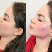 فیلر لیفت بینی و صورت وشقیقه مزوتراپی بوتاکس