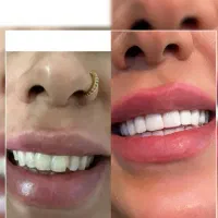 کامپوزیت دندان اقساطی|خدمات آرایشگری و زیبایی|قم, سراجه|دیوار