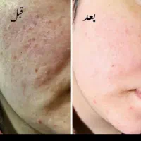 کرم‌امارتی|آرایشی، بهداشتی، درمانی|مشهد, مهدی آباد|دیوار