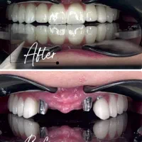 مرکز تخصصی دندانپزشکی ایمپلنت آلمانی(اقساط ۱۲ماهه)