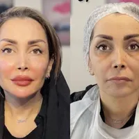 مدل روسی هایفو نخ کلینیک پوست بدون رقیب واقعی|خدمات آرایشگری و زیبایی|تهران, زعفرانیه|دیوار