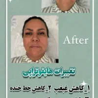 هایفوتراپی ۷بعدی تخفیف ویژه برای اولین ها|خدمات آرایشگری و زیبایی|قم, صدوق|دیوار
