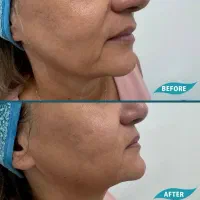 تزریق ژل و چربی، بوتاکس،هایفو|خدمات آرایشگری و زیبایی|مشهد, بهشت|دیوار