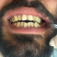 مدل کامپوزیت دندان / تخفیف ویژه