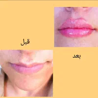 جشنواره تزریق ژل و بوتاکس وانزیم|خدمات آرایشگری و زیبایی|ملارد, |دیوار