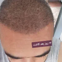 کاشت مو و ابرو با خط رویش طبیعی و پر تراکم|خدمات آرایشگری و زیبایی|تهران, پاسداران|دیوار