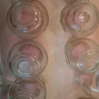 آموزش خصوصی بادکش گرم و حجامت در مطب