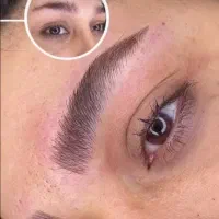 فیبروز. میکرو بلیندینگ