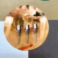 ایمپلنت تخصصی فوری