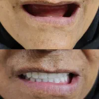 دندانسازی،دندان مصنوعی،جوان پسند،اقساطی با چک|خدمات آرایشگری و زیبایی|مشهد, شاهد (شهرک غرب)|دیوار