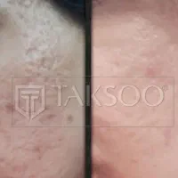 پک منافذ پوست|آرایشی، بهداشتی، درمانی|اهواز, باغ شیخ|دیوار