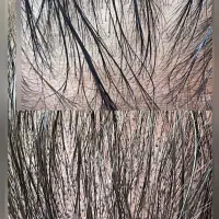 (میکرو اسکالپ سر ).مزو مو