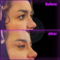 جشنواره ویژه بلفاروپلاستی(جراحی زیبایی پلک)