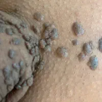 رفع قطعی و ریشه ای زگیل و خال گوشتی