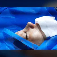 جراحی بینی عمل بینی انواع جراحی زیبایی|خدمات آرایشگری و زیبایی|ساری, |دیوار