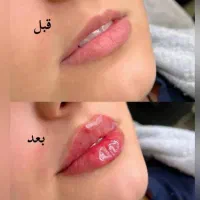 لیزر موهای زائد بدن،ژل،بوتاکس،پی آرپی،مزوژل