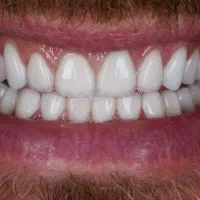 دندانپزشکی،ایمپلنت،اوردنچر با اقساط دو ساله|خدمات آرایشگری و زیبایی|اهر, |دیوار