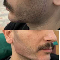 ژل لب،زاویه سازی،فیلر چانه،فول فیس|خدمات آرایشگری و زیبایی|مشهد, عسگریه|دیوار