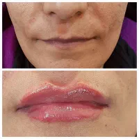 آموزش و تزریق ژل و بوتاکس ومزو|خدمات آموزشی|شیراز, تندگویان|دیوار