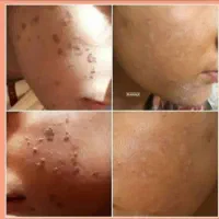 درمان قطعی و بدون بازگشت زگیل و تبخال نواحی خصوصی|خدمات آرایشگری و زیبایی|ساری, |دیوار