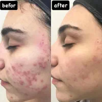جشنواره فشیال تخصصی با ۵۰٪ تخفیف فقط برای ۵ نفر|خدمات آرایشگری و زیبایی|یزد, |دیوار