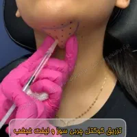 آنزیم ژل فیلر مزو بوتاکس فیشیال لابیا تنگی هودکتوم|خدمات آرایشگری و زیبایی|مشهد, آزادشهر|دیوار