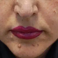 برداشتن انواع خال و لک و کک و مک