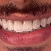 دندانپزشکی بامناسب‌ترین قیمت ایمپلنت درمانی زیبایی|خدمات آرایشگری و زیبایی|تهران, فلسطین (میدان انقلاب)|دیوار