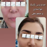 کلینیک زیبایی گلد( فیلر ژل بوتاکس) توسط پزشک|خدمات آرایشگری و زیبایی|سنندج, |دیوار