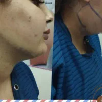 آف فوق ویژه‌ی ساکشن ۳۶۰ درجه فقط ۲۰ت