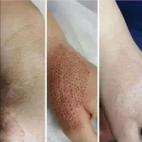 برداشتن خالهای گوشتی و سطحی