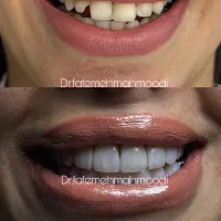 کامپوزیت.لمینیت.ایمپلنت|خدمات زیبایی و سلامت|تهران, سعادتآباد|دیوار