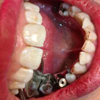 ایمپلنت/عصب کشی/لمینت/کامپوزیت/بلیچینگ دندانپزشکی