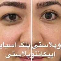 تخفیف ویژه لیزربوتاکس،مزوتراپی در ماهشهر(پتروکارت)