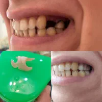 دندان متحرک مصنوعی بجای ایمپلنت فوری و سریع|آرایشی، بهداشتی، درمانی|رشت, گلسار|دیوار