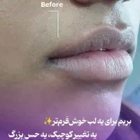 تزریق فیلر وبوتاکس با قیمت استثنایی