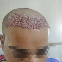کاشت مو