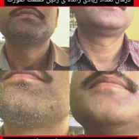درمان ریشه ای تبخال و زگیل تناسلی با گیاهان دارویی|خدمات آرایشگری و زیبایی|اهواز, گلستان|دیوار