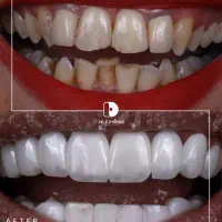 کامپوزیت/لمینت/دندانپزشکی|خدمات آرایشگری و زیبایی|مشهد, کوثر|دیوار