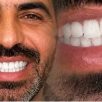 کامپوزیت/دندانپزشکی/عصبکشی/لیرینگ/ترمیم پالیش