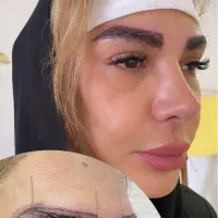 کاشت ابرو