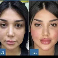 جشنواره تزریق بوتاکس وژل. فیلرکل صورت از ۷میلیون|خدمات آرایشگری و زیبایی|بردسیر, |دیوار