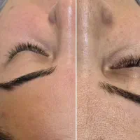 آموزش تخصصی فیشال و پاکسازی پوست