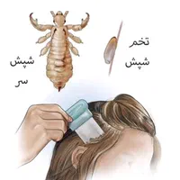 درمان کامل شپش تظمینی