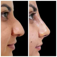 اصلاح قوزوافتادگی بینی بدون جراحی در مطب( تضمینی)|خدمات آرایشگری و زیبایی|شاهینشهر, فردوسی|دیوار