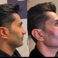 غبغب بلفارو اِندسکوپیک لیفت شقیقه پروتز لیپو