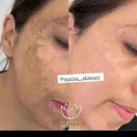 فیشال تخصصی، برداشت خال و ککو مک، ژل و بوتاکس