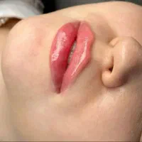 مدل ژل و بوتاکس توسط پزشک فوری