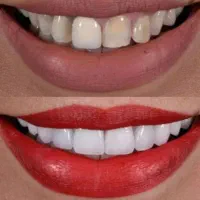 برطرف کردن تمام عیوب دندان|آرایشی، بهداشتی، درمانی|سیرجان, |دیوار