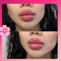 ژل و بوتاکس باآفر ویژه و قیمت منصفانه